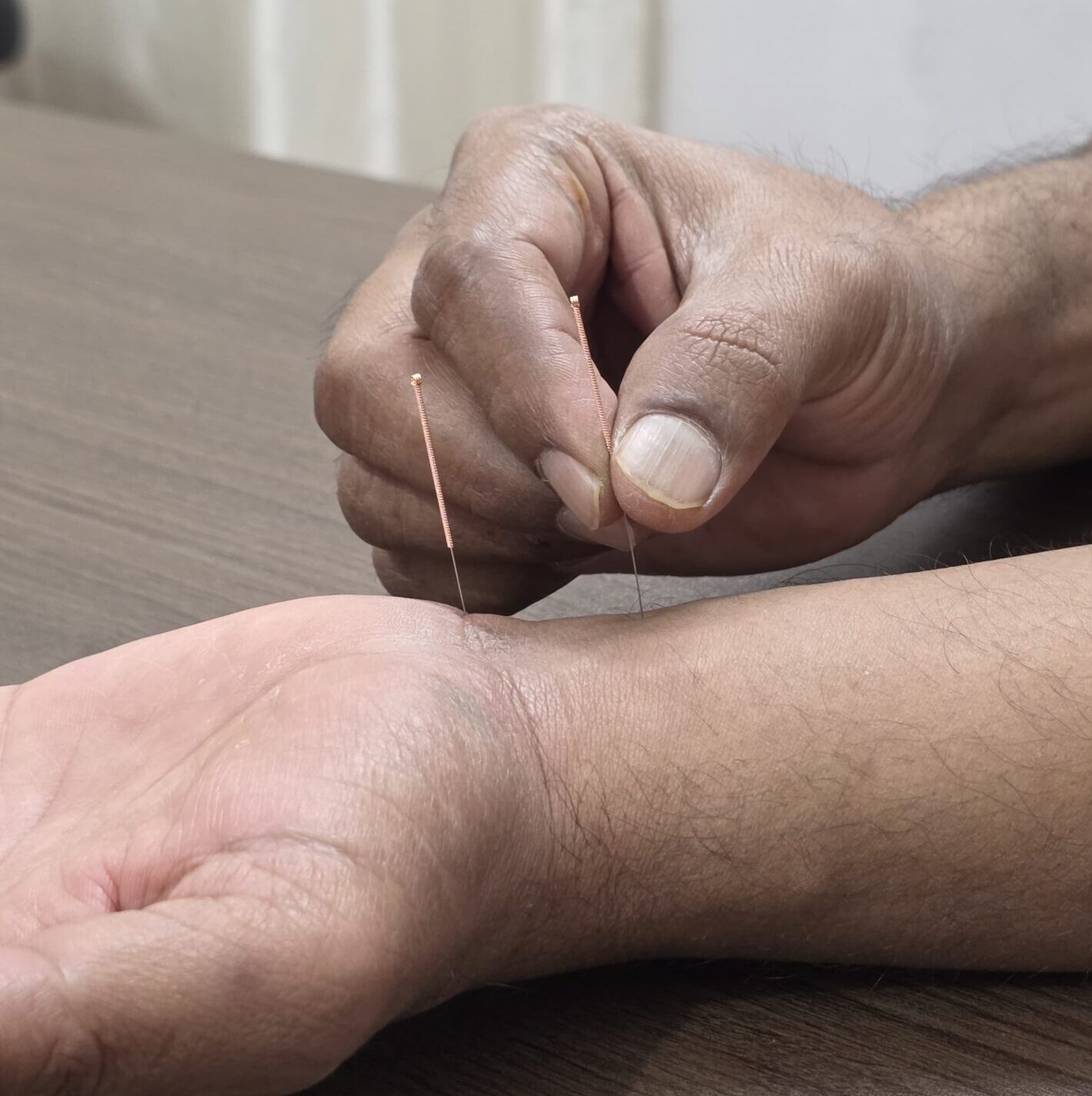 MBS acupressure and acupuncture treatment